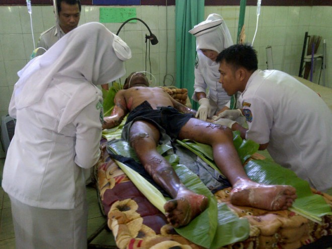 Korban Dwi saat diberikan perawatan oleh tenaga medis, tubuhnya dipenuhi luka bakar